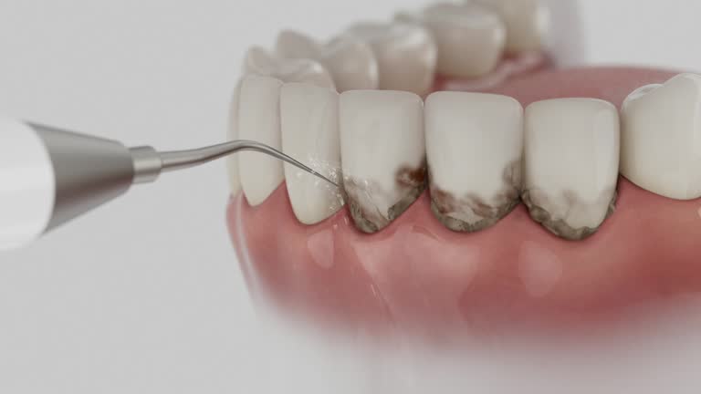 Reliable Dental Implants contractor in Groves, TX by Smile Center Dentistry